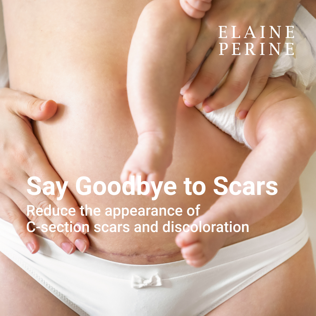 C-SECTION SCAR OINTMENT