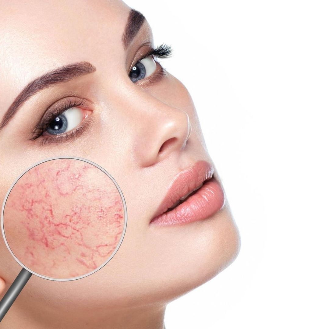 Couperose Serum